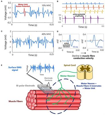 Analysis and Biophysics of Surface EMG for Physiotherapists and Kinesiologists: Toward a Common Language With Rehabilitation Engineers